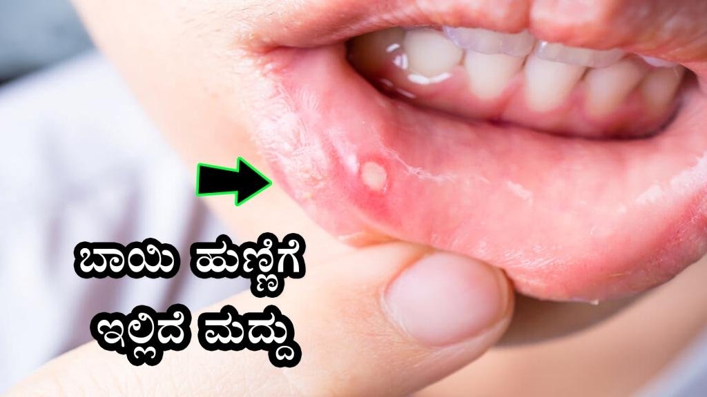 ಬಾಯಿ ಹುಣ್ಣಿಗೆ ಇಲ್ಲಿದೆ ಮದ್ದು - Mouth ulcer home remedies